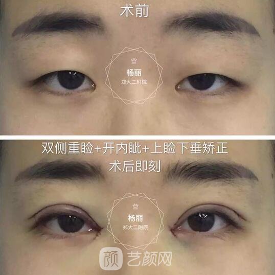 雙側(cè)重瞼+內(nèi)外眥開大+雙側(cè)上瞼下垂矯正