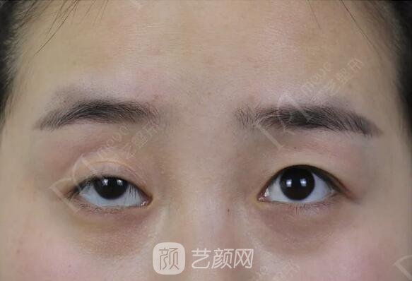 上瞼下垂如果不重視雙眼皮做了也白做！