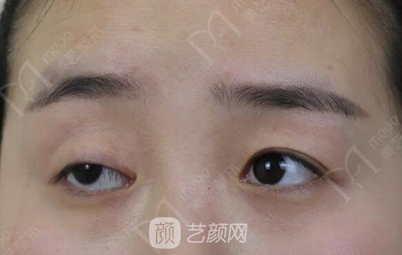 上瞼下垂如果不重視雙眼皮做了也白做！
