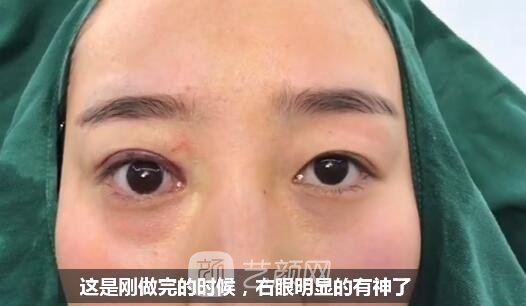 上瞼下垂如果不重視雙眼皮做了也白做！