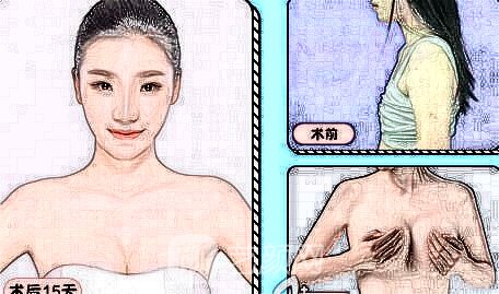 隆胸優(yōu)惠活動價錢大約多少錢?