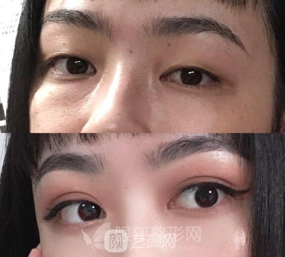 北京做雙眼皮手術(shù)果好不好 案例