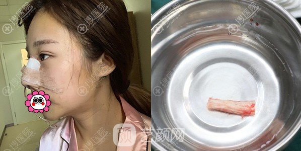 北京畫美于智宏自體肋軟骨隆鼻案例