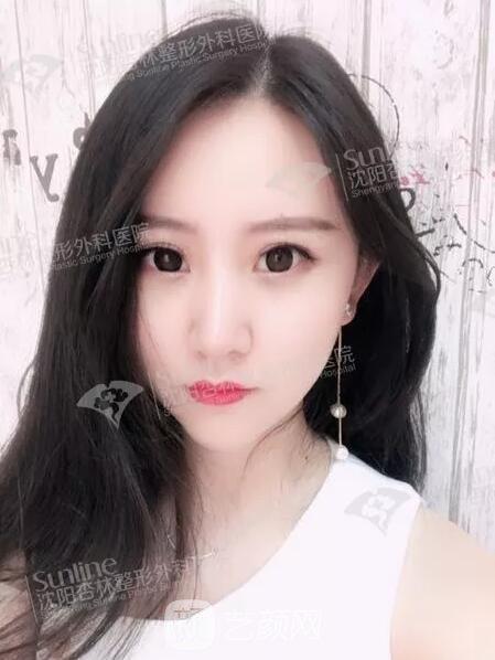 沈陽杏林張宇夫鼻部手術(shù)案例