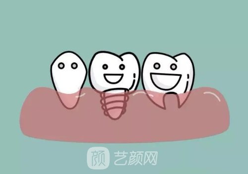 韓國(guó)美格真種植體的優(yōu)缺