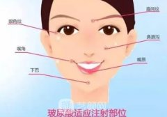 愛芙萊玻尿酸可以填充法