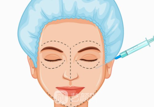 愛芙萊玻尿酸和薇力玻尿