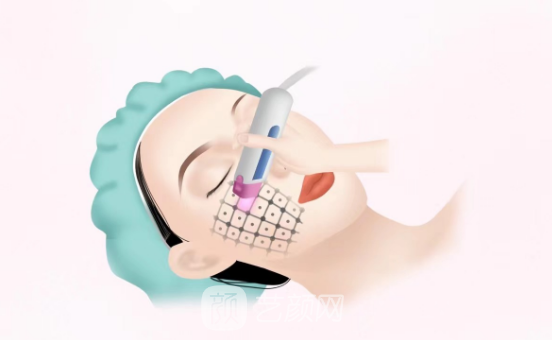 青春定格手術(shù)全過程危險(xiǎn)