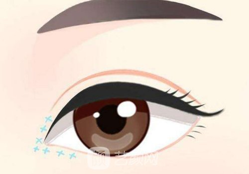 內(nèi)眼角回包一般能成功嗎