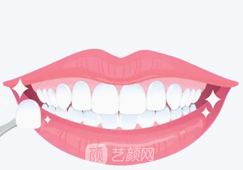 鑄瓷貼面和全瓷貼面價格