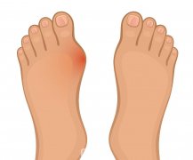 蘇敬達做大腳骨手術技術