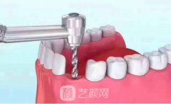 奧齒泰種植牙價(jià)格多少錢