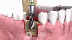 法國(guó)安卓健種植牙是什么