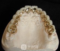 純鈦金屬牙齒好不好？當(dāng)