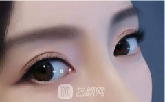 埋線雙眼皮能維持幾年？